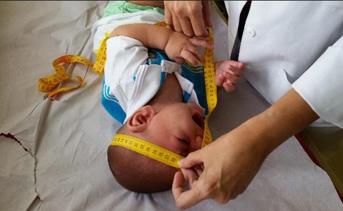 브라질서 소두증 신생아 사망 급증…"공공보건 서비스 열악"