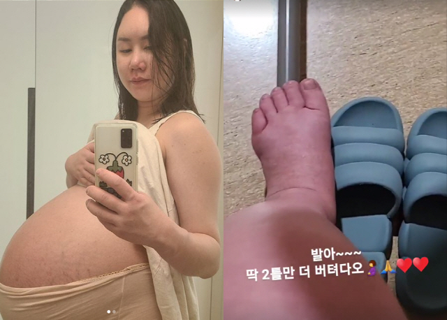'104kg' 황신영, '세쌍둥이 임신'에 휠체어 신세→퉁퉁 부은 발…"…