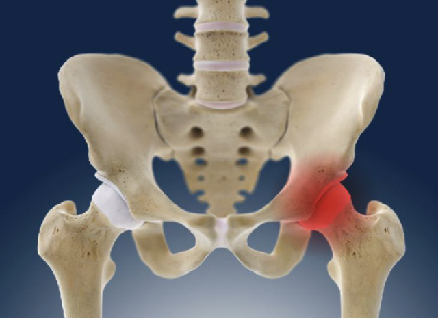 잦은 술자리, 뼈가 죽는다…찌릿한 엉덩이 통증 '대퇴골두 무혈성 괴사' …