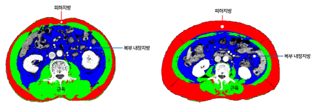 비만의 역설?…"고지방 비만 환자 대장암 재발 위험 낮다"