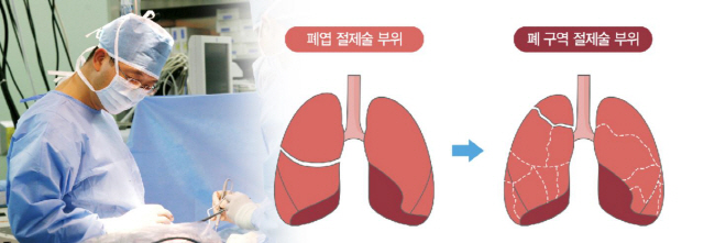 폐암 조기 발견하면 작은 구역만 잘라도 폐 기능-생존율 향상