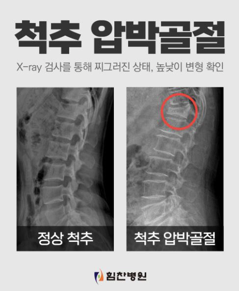 겨울철 낙상사고 빈번, 고령층 요추골절 주의보