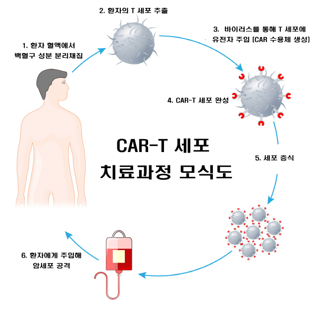 서울대병원 "소아백혈병 CAR-T 치료제, 국내 첫 병원 생산 추진"