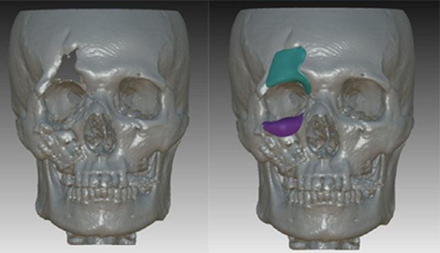안면골·두개골 결손, 3D 프린터 활용 맞춤형 인공 뼈로 재건