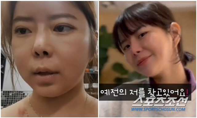 '이수근♥'박지연, 스테로이드 부작용으로 문페이스 '충격'…얼굴 부어 '…