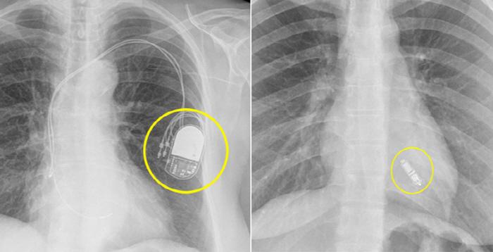 일산백병원 지역 첫 '무선 심박동기 삽입술' 시행…기존 심장박동기 대비 …