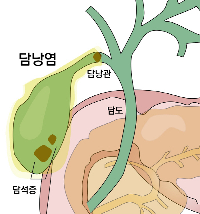 오른쪽 윗배·명치 통증 '담낭염' 방치 땐 패혈증으로 발전 가능