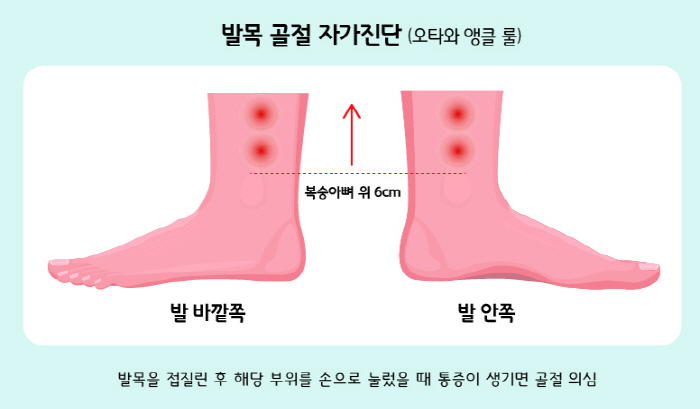 삐끗한 발목, 골절 자가진단? 복숭아뼈 위를 꾹 누르면…