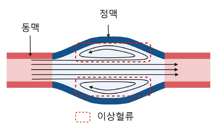 혈관 협착 막는 투석혈관 기기 개발…협착증 5배 감소·혈류량 2.5배 증…