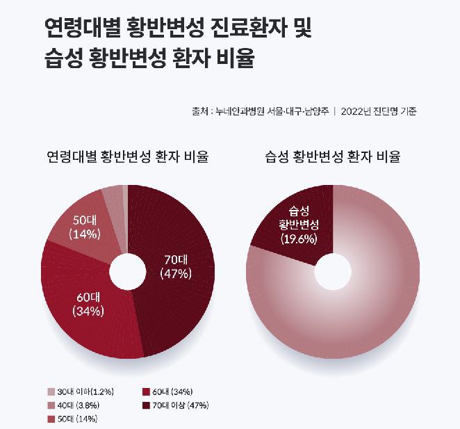 실명질환 '황반변성', 50대 이상 환자 95%…초기에 노안으로 오해