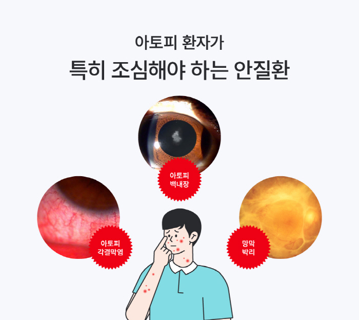 아토피 피부염으로 인한 망막박리, 실명까지 유발?