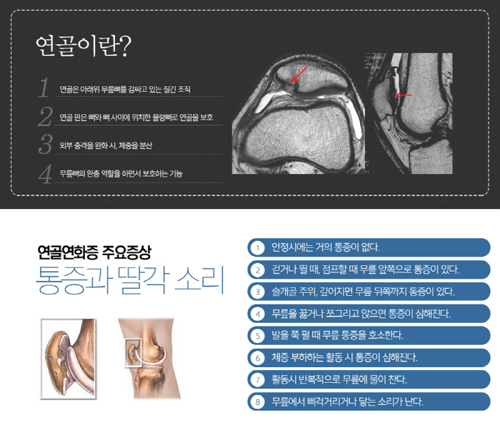 운동 즐기는 젊은층 무릎 통증, 혹시 '연골연화증'?