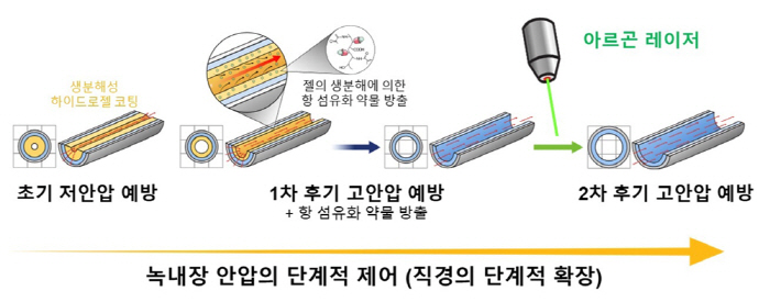 연세의대, 녹내장 진행 맞춰 안압 조절 가능한 치료 튜브 개발