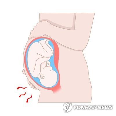 "초미숙아에 DHA 투여 효과 없어"