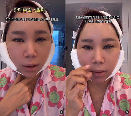 '강원래♥' 김송, 이번엔 광대수술 "찐감자 얼굴에 남편·아들 빵빵터져"