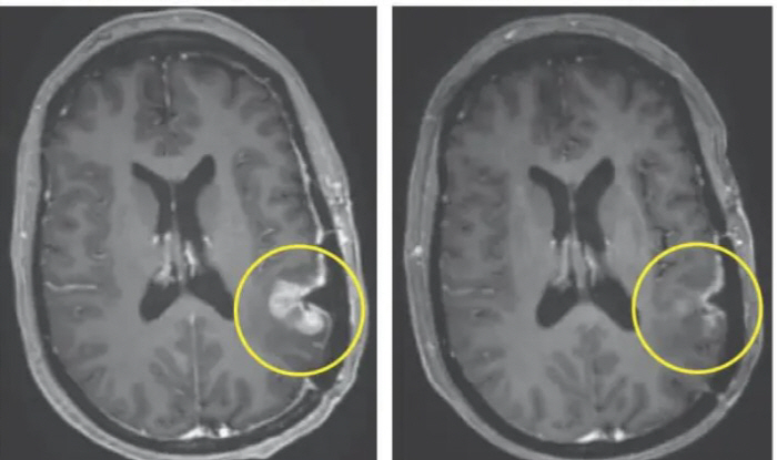 뇌종양 '교모세포종' 환자 5일 만에 기적 만든 치료는?
