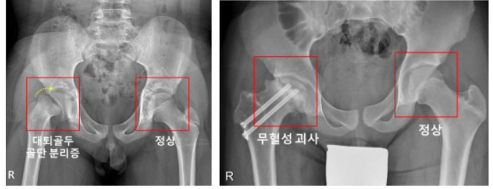 대퇴골두 골단 분리증 발병률 세계 최초 규명…호르몬 부족땐 최고 744배…