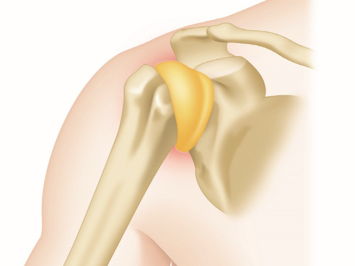 박수홍·김구라 어깨 괴롭힌 '오십견', 원인과 치료는?