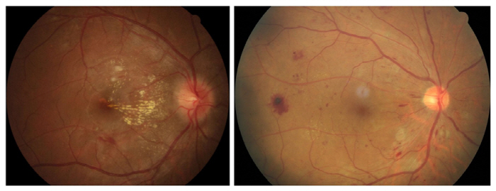 젊은층 시력저하 부르는 '고혈압망막병증'·'당뇨망막병증' 주의