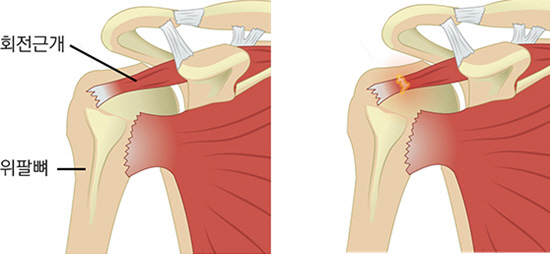 어깨 마찰음에 밤에 통증 심하면 '회전근개 파열' 의심, 치료는?