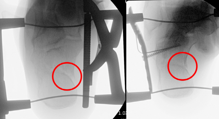 12㎝ 이상 절개하던 뒤꿈치뼈 골절, 경피적 수술로 치료