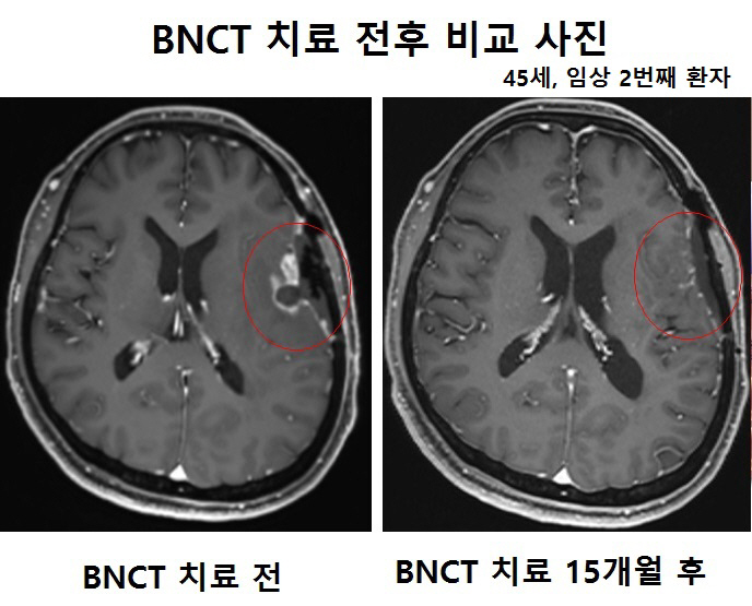 가천대 길병원, '꿈의 암 치료기' A-BNCT 임상 1상 미무리