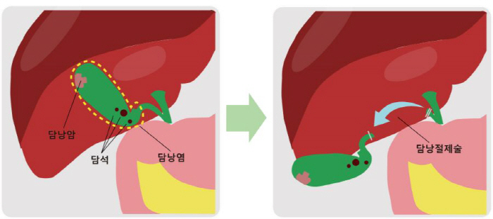 명치·오른쪽 윗배 통증, 혹시 담낭염?…담낭암 5년 생존율 27% 불과