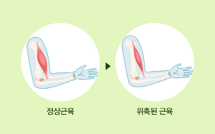 병뚜껑 못 따고 발음 어눌해지면 '루게릭병' 의심…디스크·뇌졸중 오인도