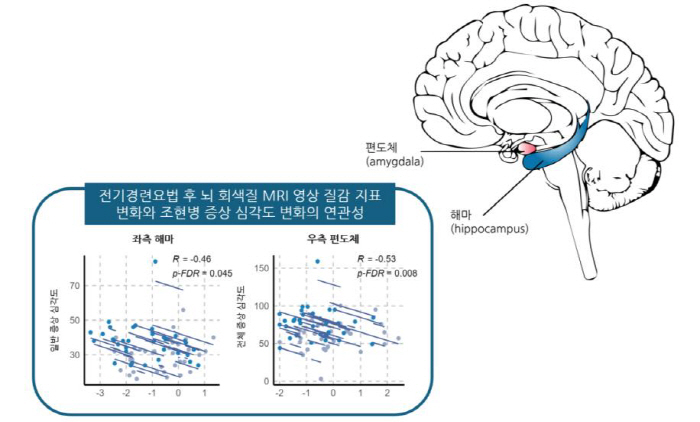 전기경련요법과 치료 저항성 조현병 환자의 뇌 구조 변화 연관성 규명