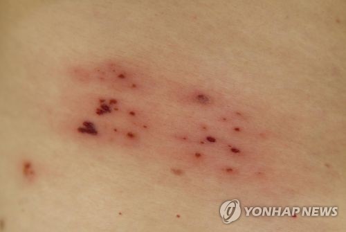 "장기 저용량 항바이러스 치료, 대상포진 통증·안질환에 효과"