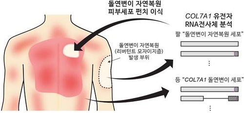 '가벼운 마찰에도 상처·수포' 희귀피부병 국내서 치료법 찾았다