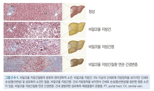 [위클리 건강] "술도 안 마시는데 지방간?…교대근무자에 발생 위험 높아"