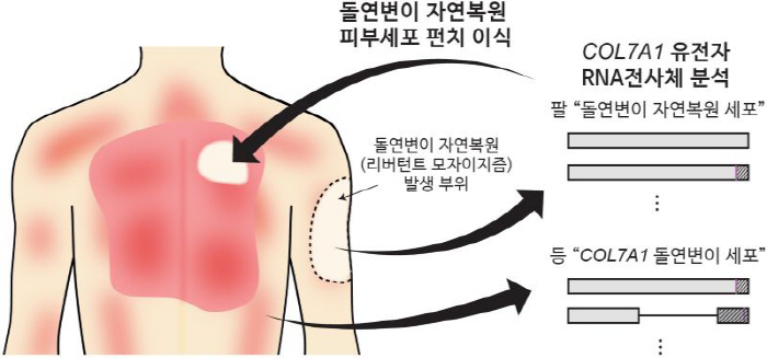 희귀 중증 유전성 피부질환 새로운 치료법 나왔다