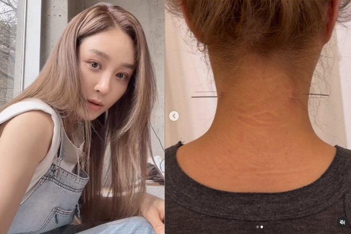 '흡연 논란' 옥주현, 이번엔 목 관통하는 장침 꽂았다 '끔찍'