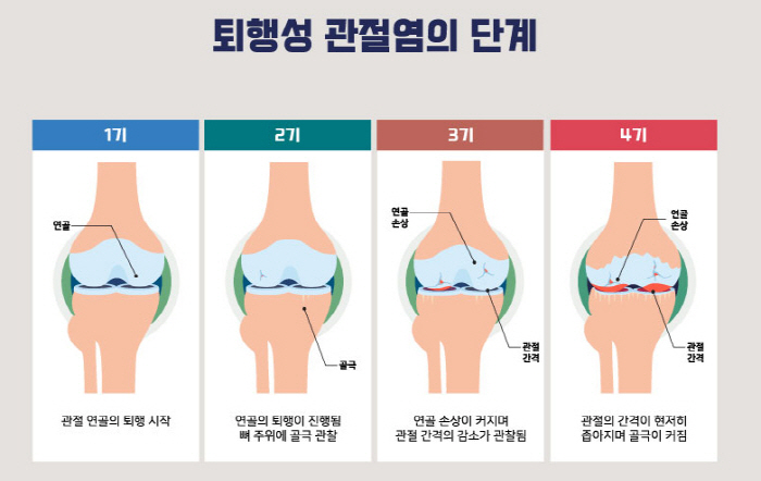 "찬바람에 엄마 무릎 걱정되네"…혈액 순환 저하·근육 경직으로 통증 악화