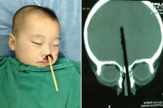 젓가락이 2살 아이의 코 관통, 뇌에 박혀