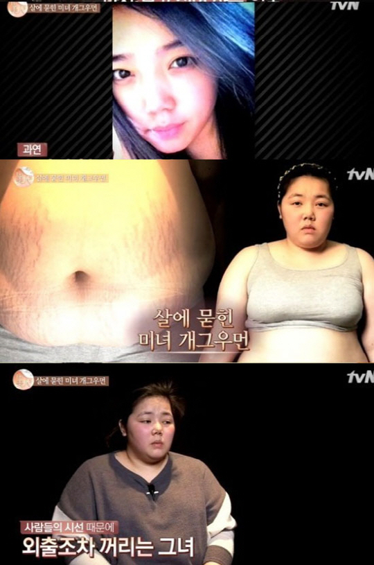 '렛미인' 살에 묻힌 미녀 개그우먼, 몸무게 110kg-허리 50인치 '…